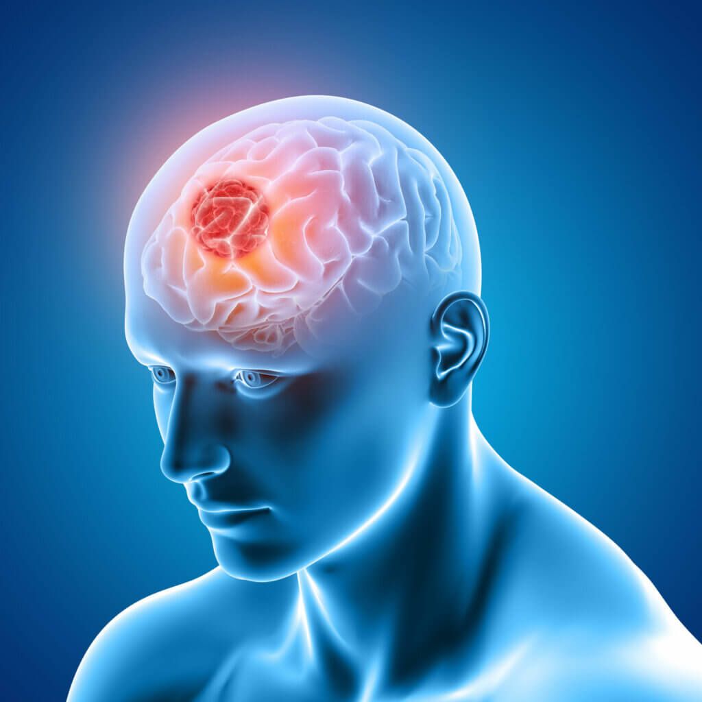 Woman experiencing persistent headaches and dizziness, highlighting early warning signs that may be associated with a brain tumor.